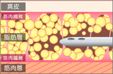 脂肪吸引のイメージ01